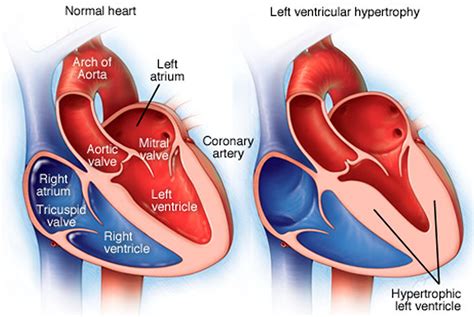 left ventricular hypertrophy and heart failure.